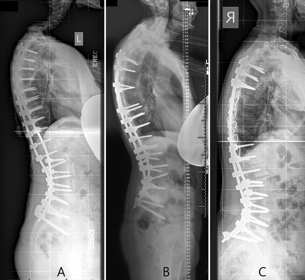 Surgery for deformity spine In Chhindwara