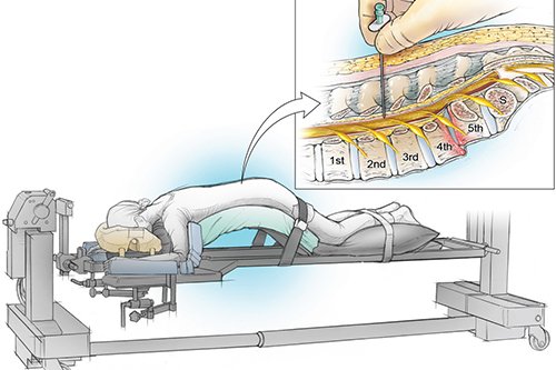 Awake Spine Surgery In Nagpur