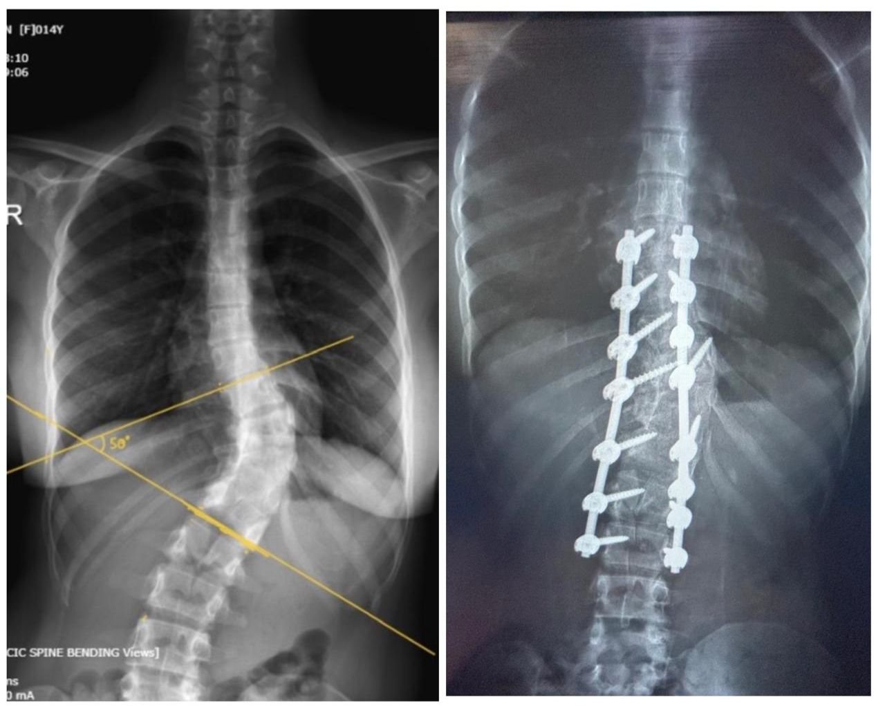 Congenital Scoliosis Correction with Hemivertebra Excision