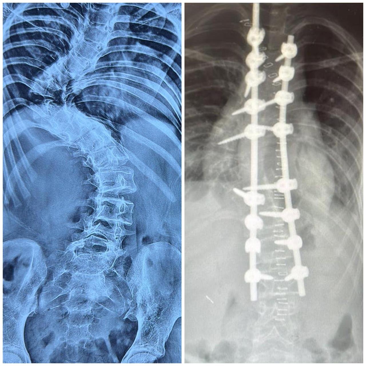 Correction of Acute Hairpin Thoracic Curve with Advanced Spine Surgery